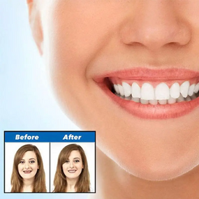 Вставные виниры для зубов Perfect Smile Veneers, Съемные виниры   скидка