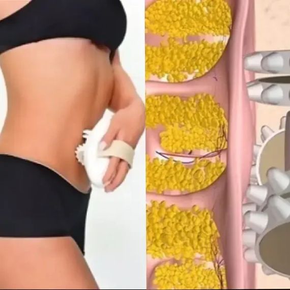 Масажер антицелюлітний Shuqin Body Slimmer SQ 100 | Зображення 2