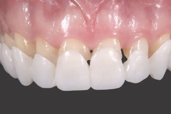 Вініри для зубів верх Snap On Smile | Зображення 2