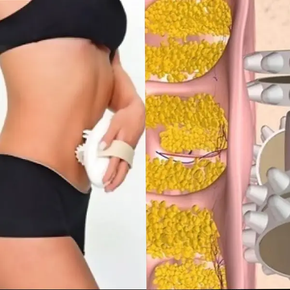 Масажер антицелюлітний Shuqin Body Slimmer SQ 100 | Зображення 2
