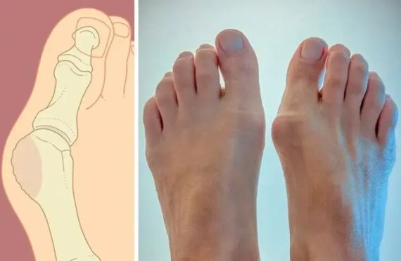 Магнитная вальгусная шина RELAX FOOT (Magnet Fix) | Магнитный корректор стопы | Зображення 7