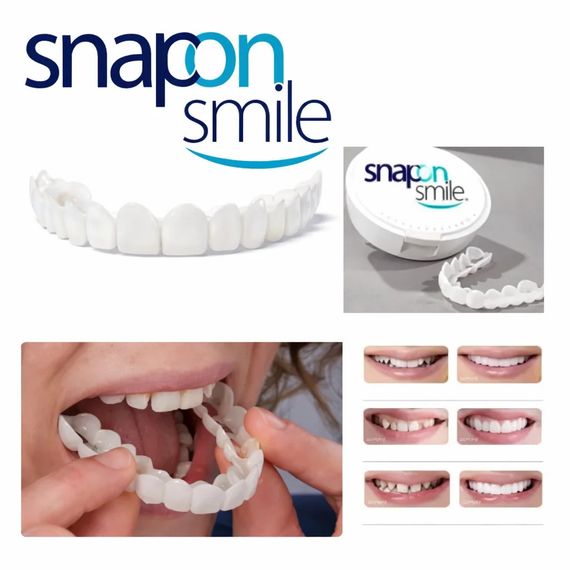 Знімні вініри для зубів Snap On Smile на 2 щелепи • Накладні вініри на верхню та нижню щелепу для красивої усмішки