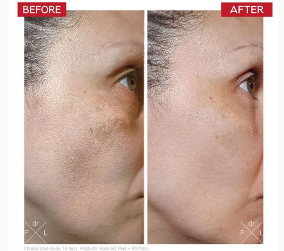 Пілінг Dr. Levy Radical3 Reboot Pro Peel (50ml) | Зображення 4