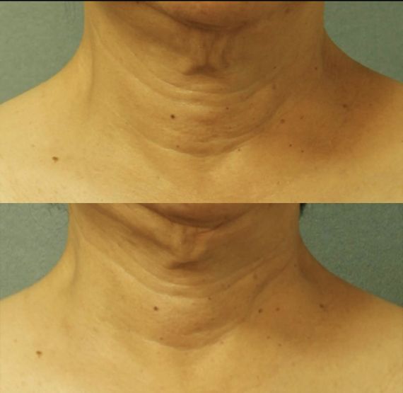 Антивіковий крем для обличчя Perricone MD Cold Plasma + Neck and Chest SPF25, 30 ml | Зображення 2