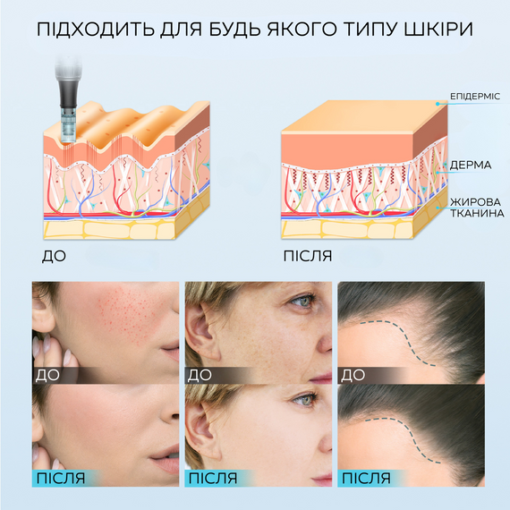 Бездротовий Автономний Дермапен Dr. Pen M7s Електричний Мезороллер Для Фракційної та Мікроголкової Мезотерапії Обличчя та Тіла | Зображення 4