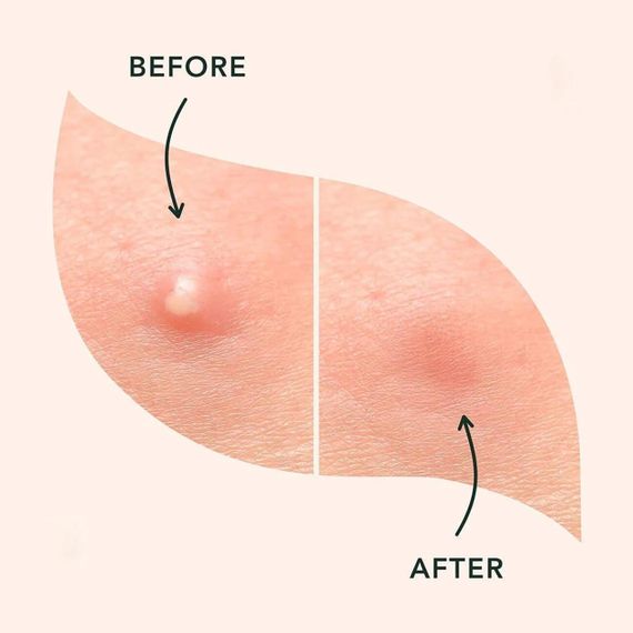 Патчі від прищів та акне 72 шт Acne Patch / Пластир косметичний для лікування акне | Зображення 6