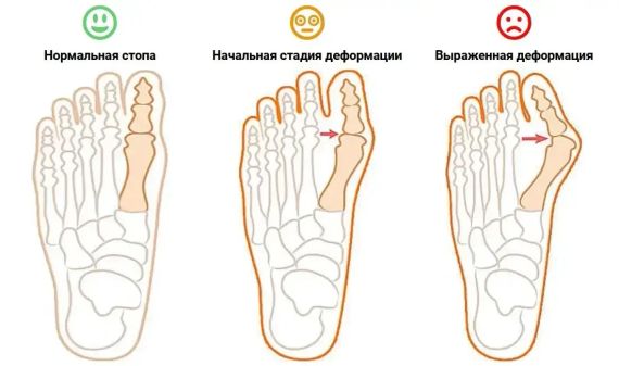 Магнитная вальгусная шина RELAX FOOT (Magnet Fix) | Магнитный корректор стопы | Зображення 6
