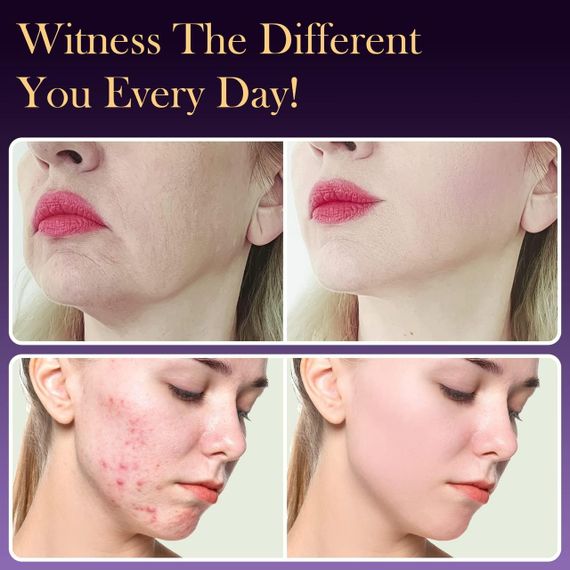 Дарсонваль косметологический аппарат для ухода за кожей лица и тела, 6 насадок | Зображення 4