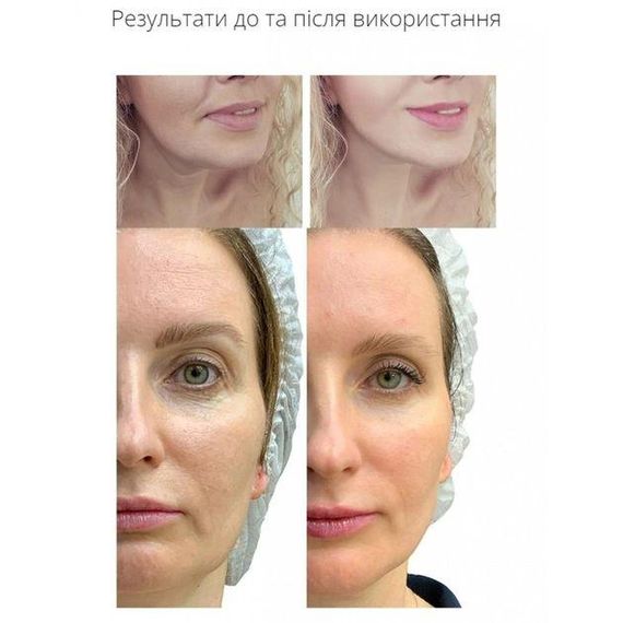 Микротоковый лифтинг-массажер для тела MEDICA+ SKIN LIFTING 5.0 гарантия 1 год | Зображення 8