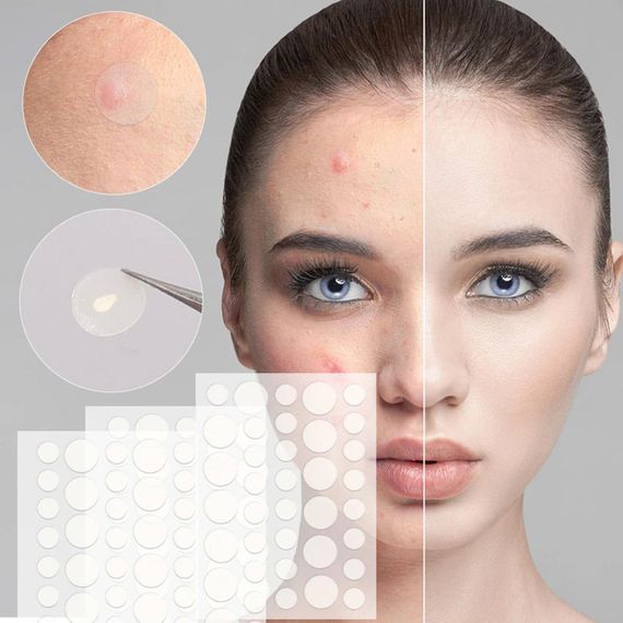 Патчі від прищів та акне 72 шт Acne Patch / Пластир косметичний для лікування акне | Зображення 5