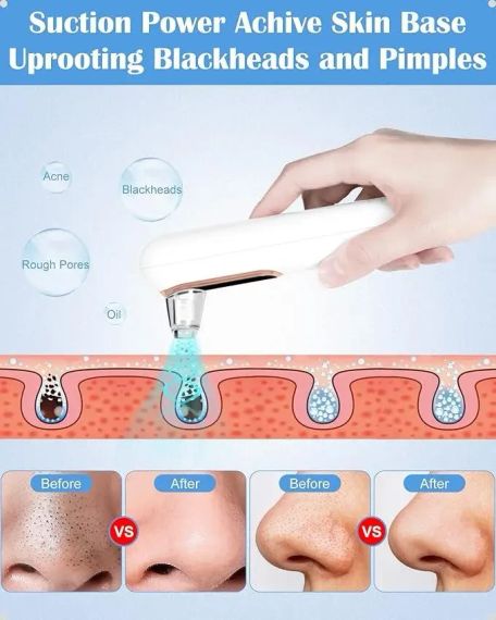Очисник пор вакуумний Blackhead Remover Y002 Апарат для видалення чорних цяток із 4 режимами та 4 насадками | Зображення 3